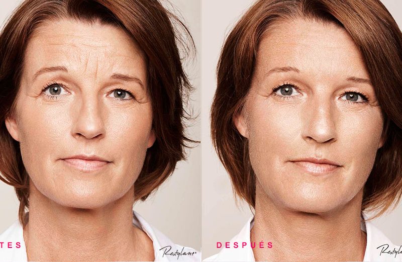 resultado rellenos faciales