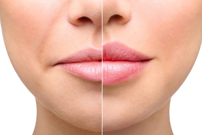 relleno labios