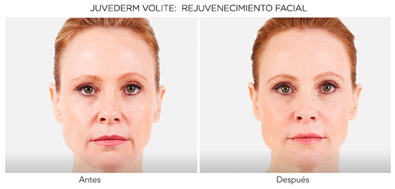 volite-antes-despues