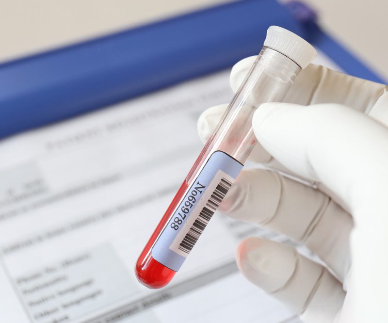 tratamiento-plasma-rico-plaquetas