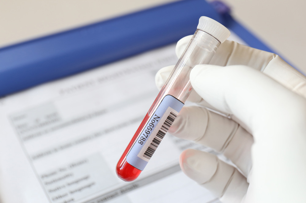 Plasma Rico en Plaquetas: antiarrugas, anticaída y antiinflamatorio