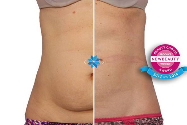 Eliminar-grasa-coolsculpting