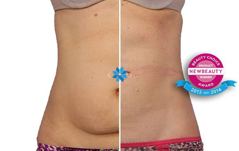 Eliminar-grasa-coolsculpting