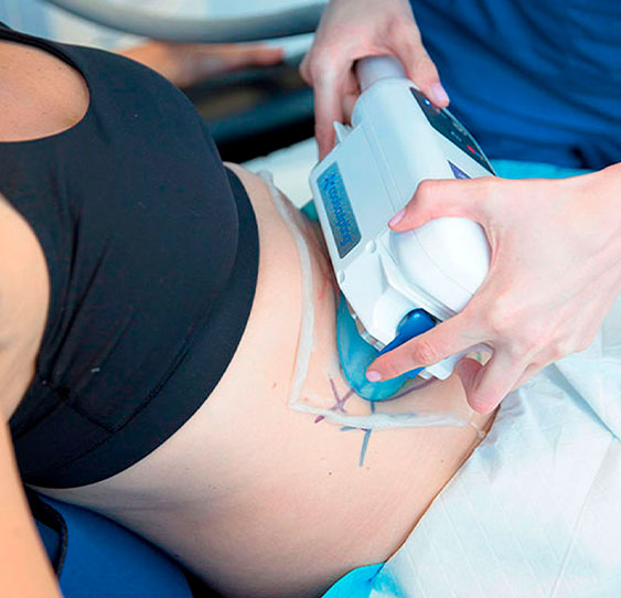 coolsculpting