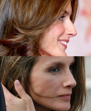 Retoque estético de mentón la reina Letizia Ortiz
