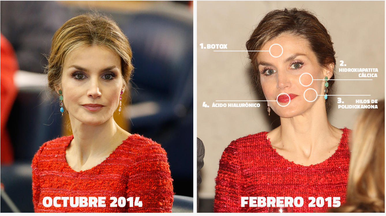 retoques estéticos de belleza de la reina Letizia
