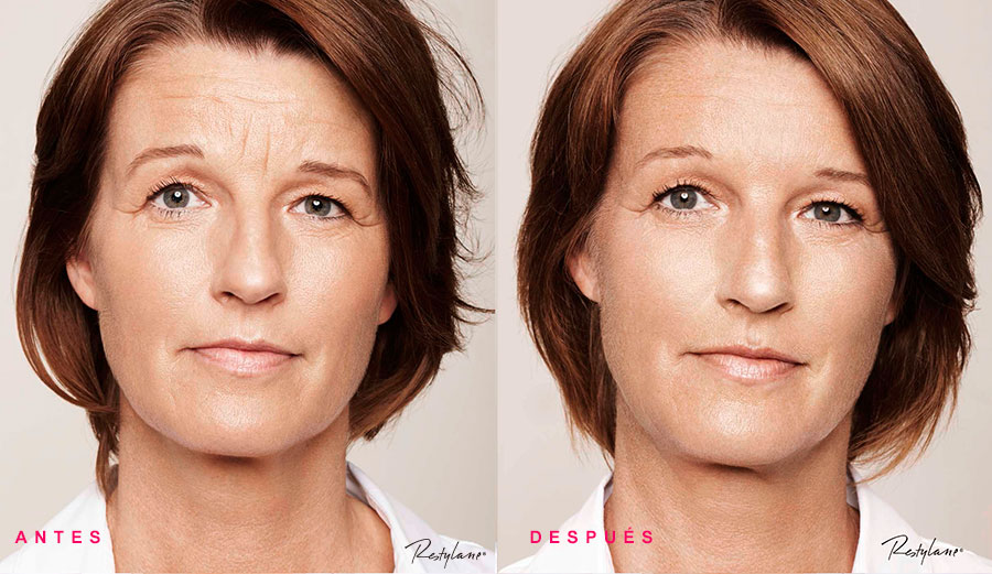 resultado rellenos faciales