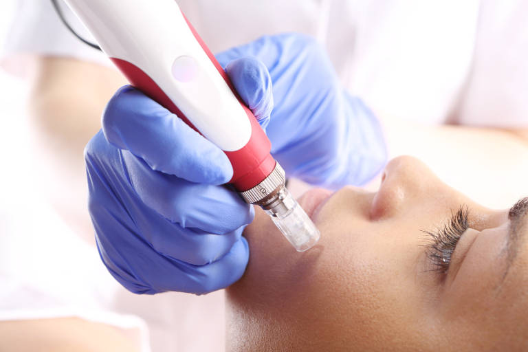 Tratamiento mesoterapia facial en Zaragoza