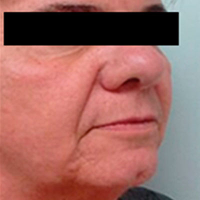 mallas tesslift resultados