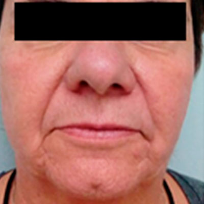 mallas tesslift resultados