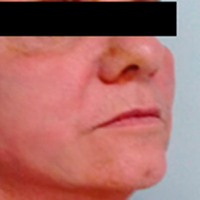mallas tesslift resultados
