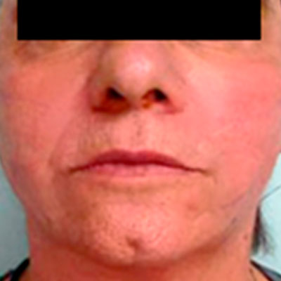 mallas tesslift resultados